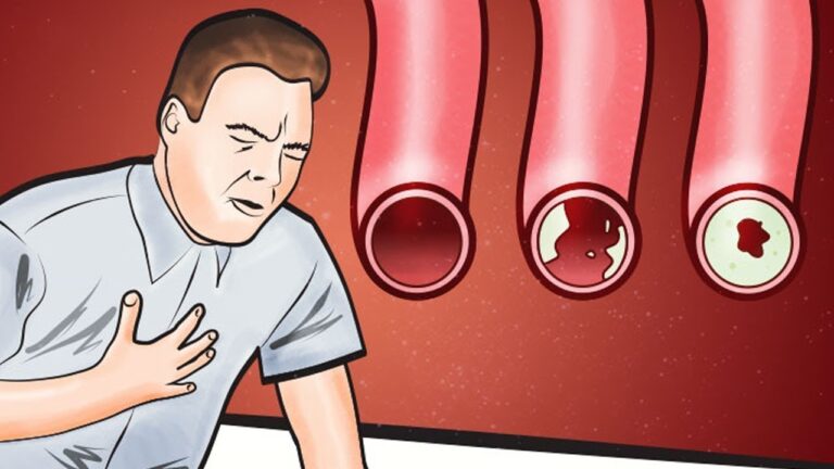7 Lebensmittel, die deine Arterien reinigen und Herzattacken verhindern können