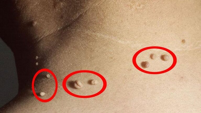 5 effektive Hausmittel gegen Hautfibrome, die du sofort ausprobieren kannst!