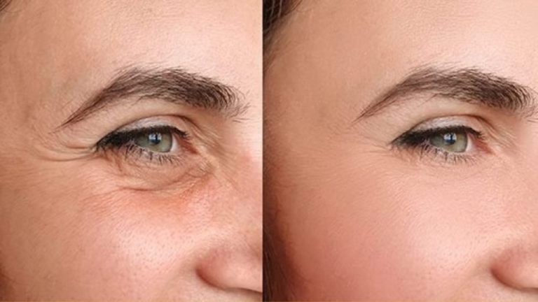 Diese natürliche Creme bannt Krähenfüße in nur einer Woche