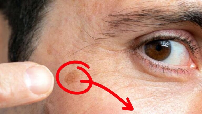 5 spannende Tipps gegen Altersflecken durch Mineralstoffmangel entdecken!