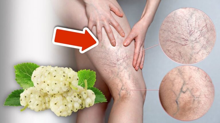 6 Geheimtipps, um Krampfadern für immer loszuwerden! Entdecke die effektiven Mittel!