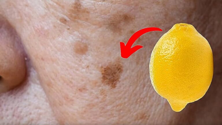 5 geniale Tipps zur Entfernung von Altersflecken mit Zitronen!