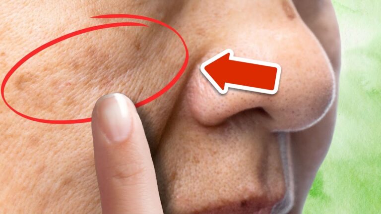 5 Schritte, um Altersflecken für immer mit dieser Pflanze zu entfernen!