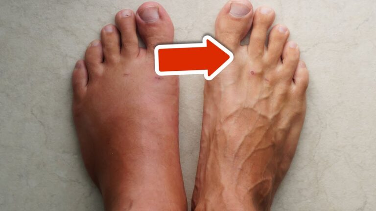 3 effektive Vitamine gegen Schwellungen in Beinen und Füßen entdecken!