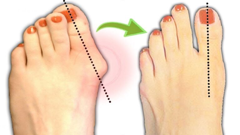 6 effektive Übungen gegen Überbeine für eine schöne Silhouette